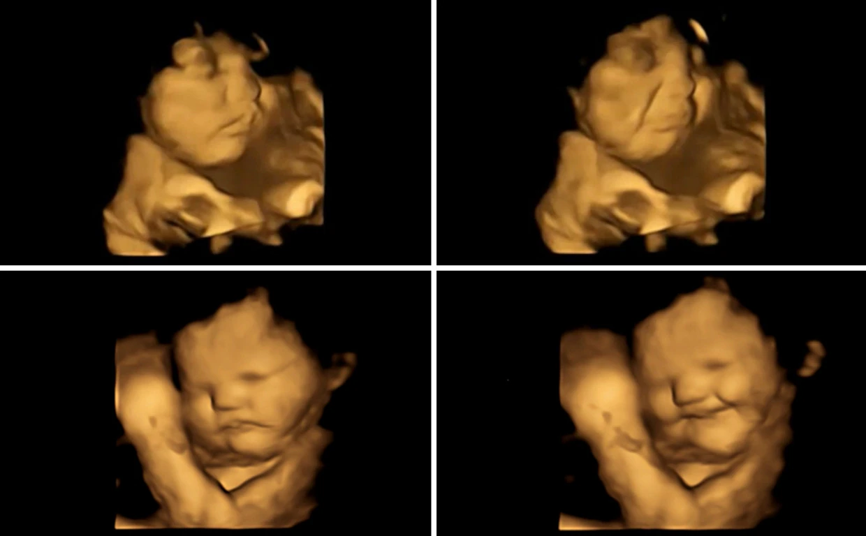 Arriba, un bebé en el feto antes (izquierda) y después (derecha) de que su madre consumiera col rizada; abajo, el mismo experimento pero después de que la progenitora consumiese zanahoria