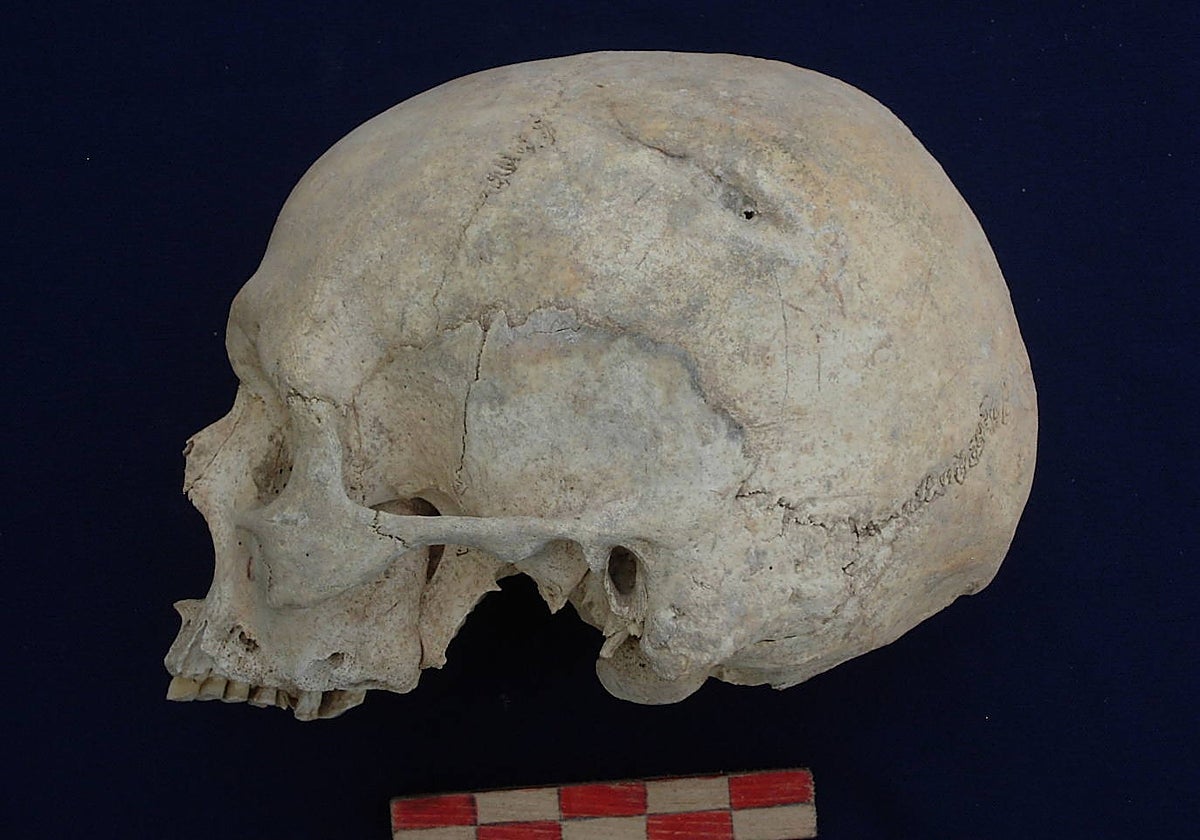 Cráneo con fracturas