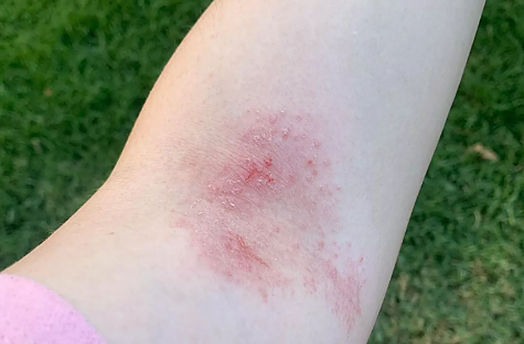 Soy alérgica al agua y así es mi día a día viviendo con esta enfermedad