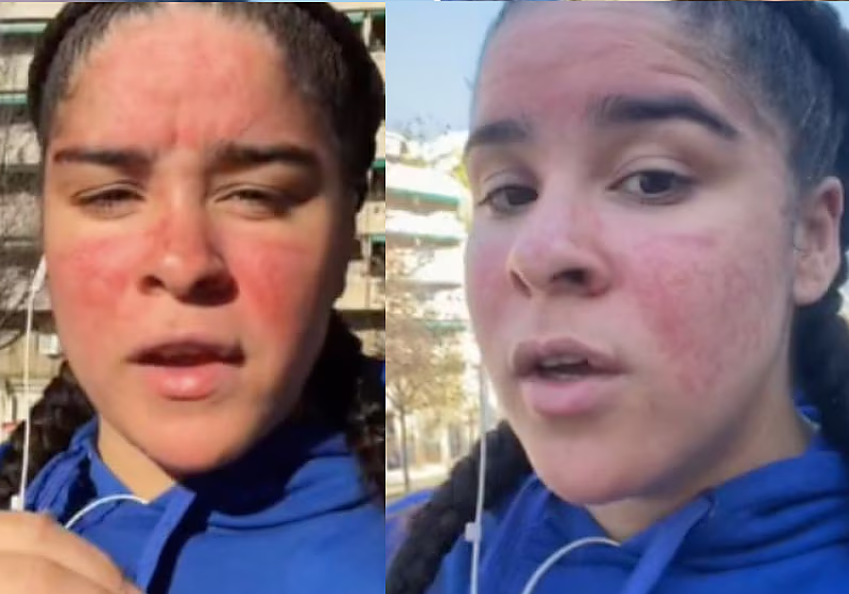 Soy alérgica al agua y así es mi día a día viviendo con esta enfermedad