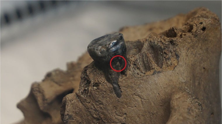 Los investigadores obtuvieron ADN de la placa dental del cráneo de Harbin