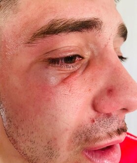 Imagen secundaria 2 - José Zambrano, del Racing Portuense, fue agredido salvamente al final del partido. Una vez en el suelo, continuó recibiendo patadas. En la otra imagen, su compañero Borja, que recibió puñetazos en el ojo y la nariz 