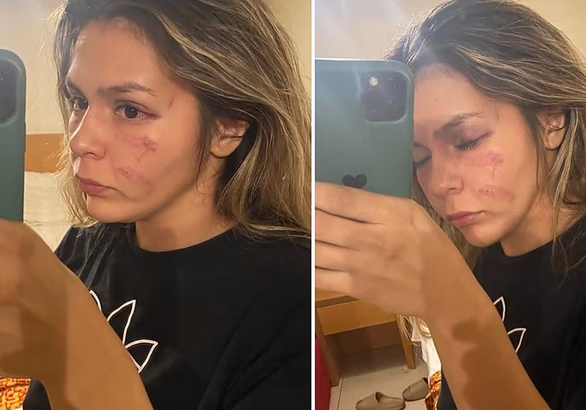 Fotos del rostro de Brianda Tamara Cruz tras la pelea con Khelif