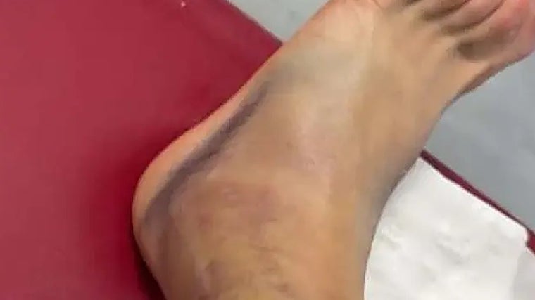 El tobillo de Januzaj tras el partido ante el Barcelona