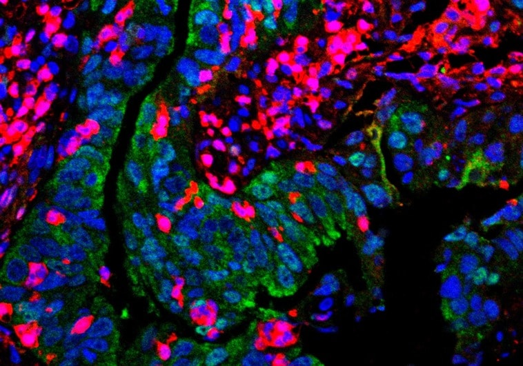Científicos españoles identifican por primera vez las células que causan las metástasis en el cáncer de colon