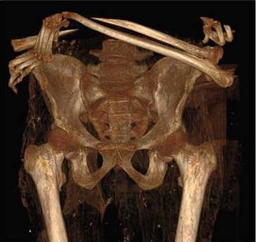 Vista frontal de la reconstrucción en 3D de la pelvis; en la parte superior se observan los brazos cruzados