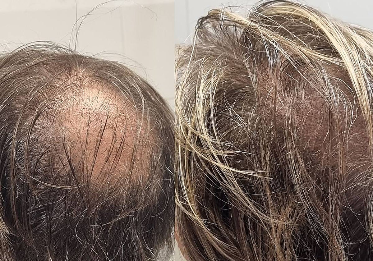 La alopecia areata afecta a un 0,2% de la población mundial