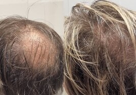 Un estudio demuestra que la alopecia en zonas localizadas se asocia con un tipo de personalidad
