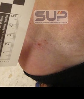 Imagen secundaria 2 - Uno de los agentes recibió una dentellada en la cabeza; también sufrió heridas en la mano y en el codo. Otro presenta una mordedura en la pierna derecha y erosiones. El tercero continúa de baja como sus compañeros