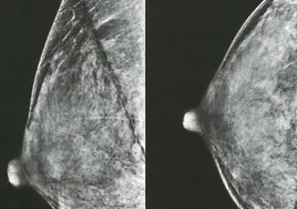 El Centro del Cáncer de Salamanca diseña un predictor de riesgo para cáncer de mama capaz de mejorar los test comerciales