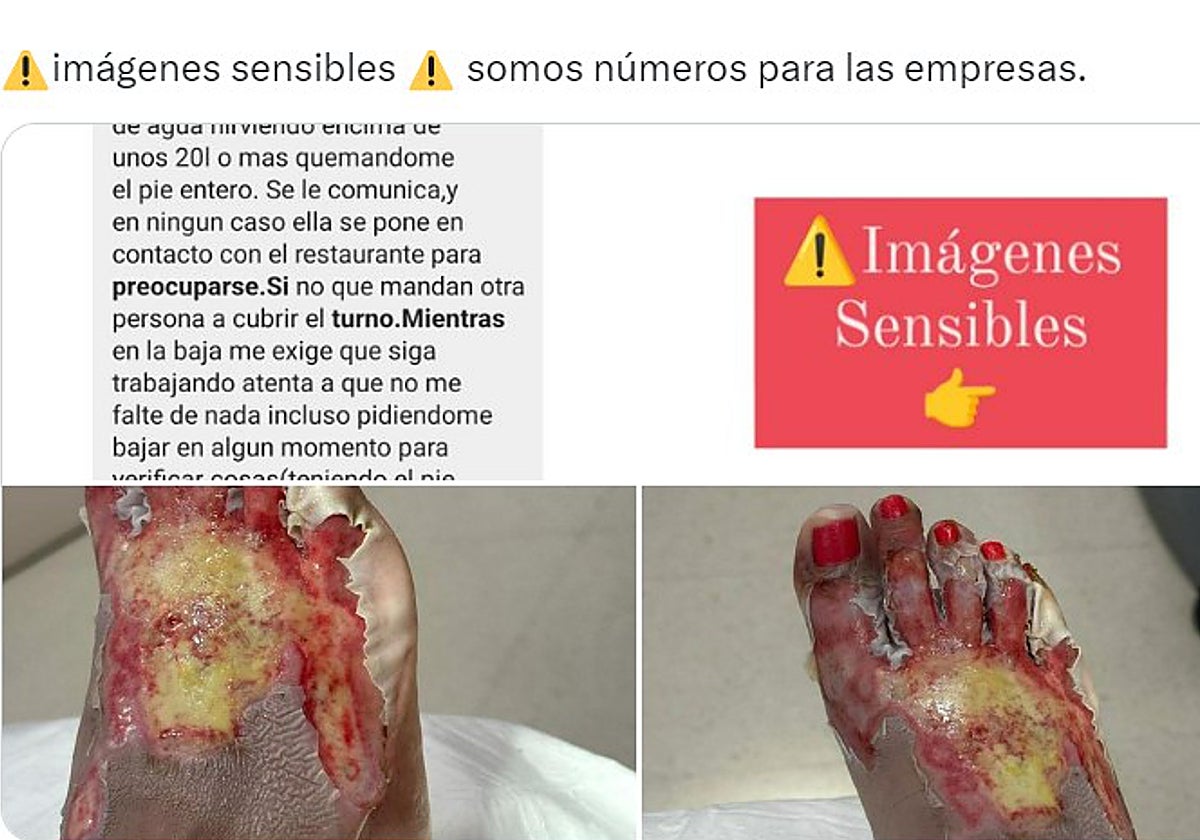 Las imágenes «sensibles» difundidas por el influencer valenciano Jesús Soriano de las quemaduras de una trabajadora del sector hostelero que sufrió quemaduras.