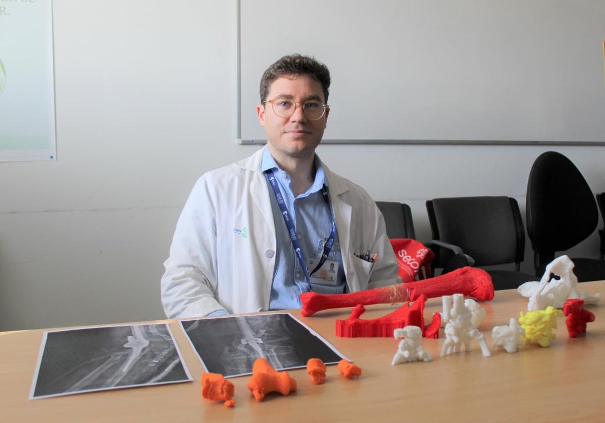 Impresión 3D para las intervenciones en traumatología en el hospital de Ciudad Real
