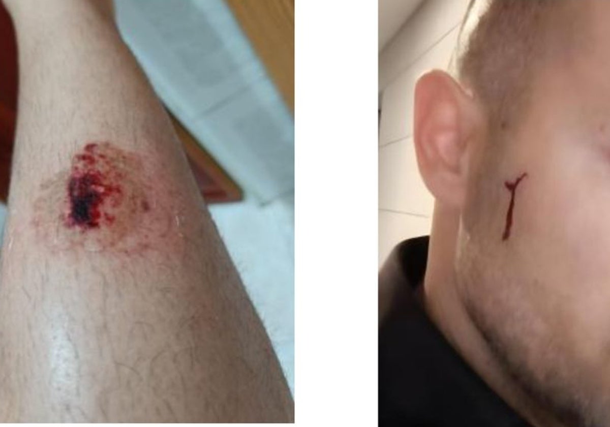 Algunas de las heridas de los agentes afectados