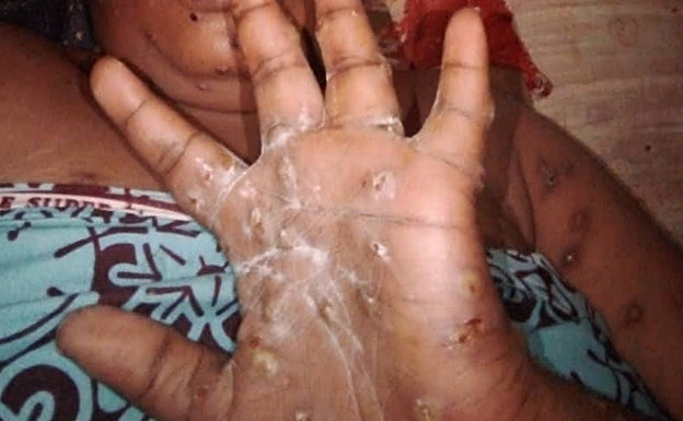 Una persona contagiada con mpox en el este de la República Democrática del Congo