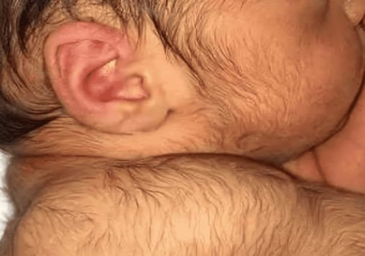 Imagen de un bebé con hípertricosis
