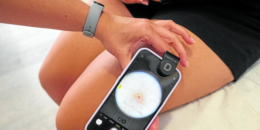 Las  fotoconsultas  para agilizar la lista de espera en Dermatología
