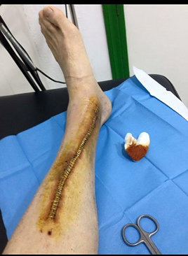 Imagen - La herida que sufrió el exagente Daniel Flores