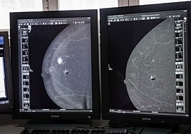 Sanidad fija servicios mínimos del 25% ante la huelga de técnicos de laboratorio, radiología y anatomía patológica en Castilla-La Mancha