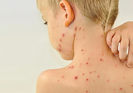 Se elevan a 21 los casos de sarampión detectados en el brote de La Palma