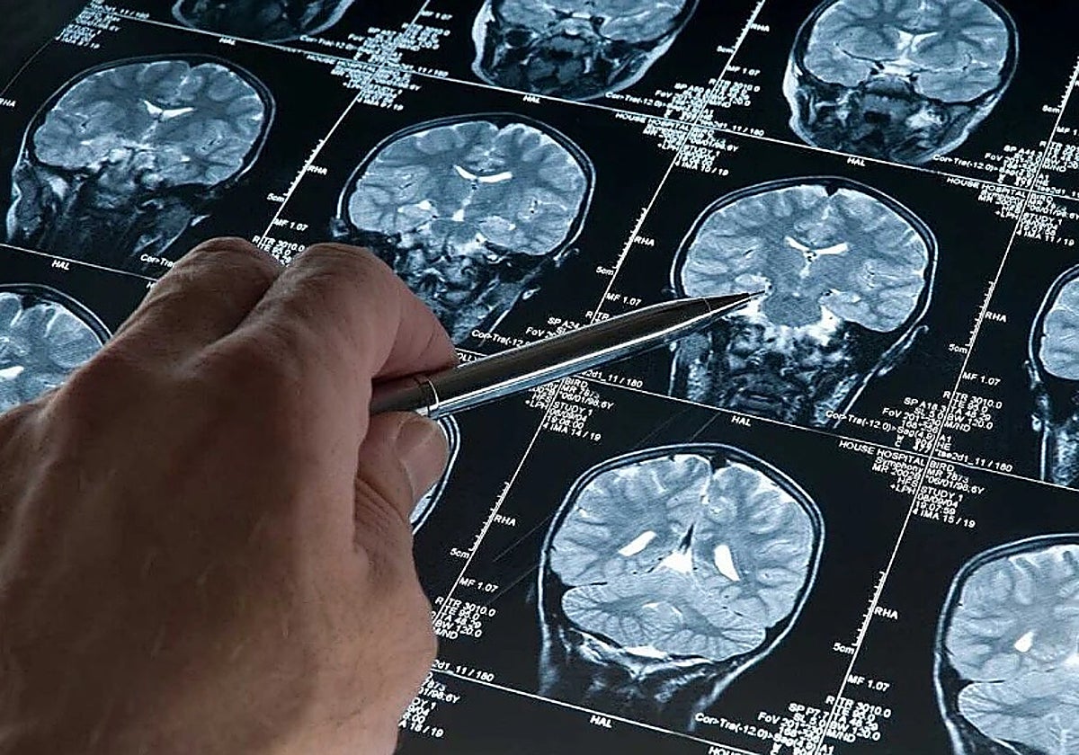 Un sanitario señala una radiografía del cerebro