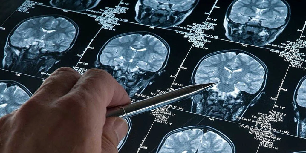 Científicos "escuchan" la estructura del cerebro humano con técnicas de cosmología