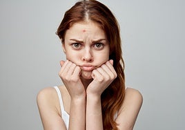 Adolescentes: ¿Me puedo poner crema solar si tengo acné?