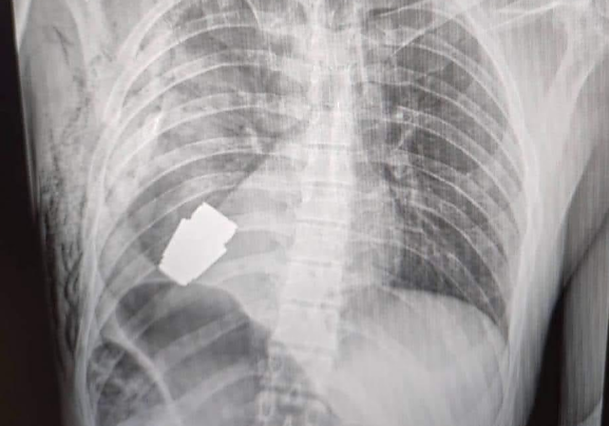 Radiografía de la granada incrustada en la zona torácica de un soldado ucraniano.