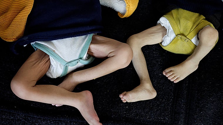 Consecuencias de la desnutrición en Gaza