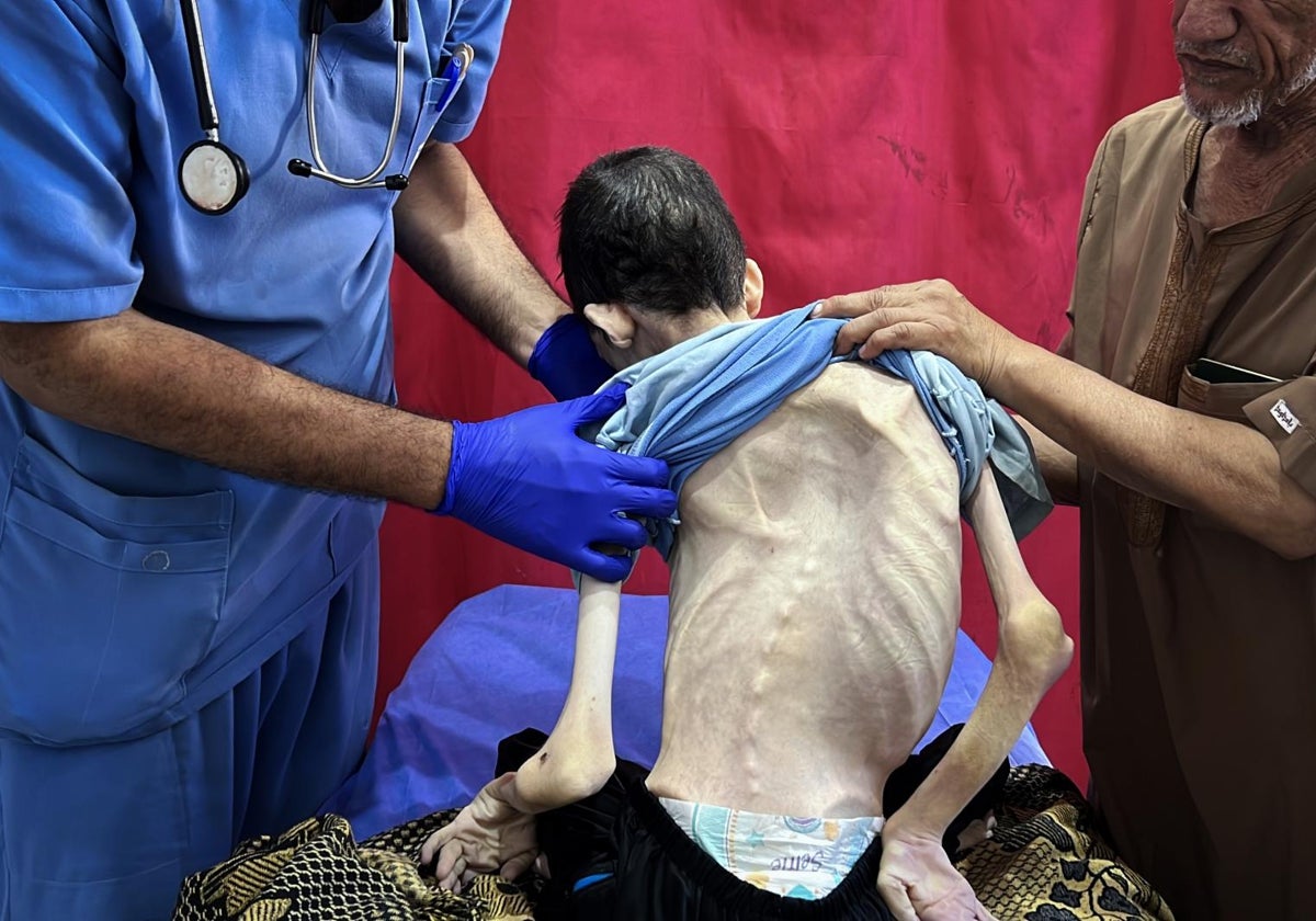 Los médicos inspeccionan el cuerpo de un palestino muerto de hambre