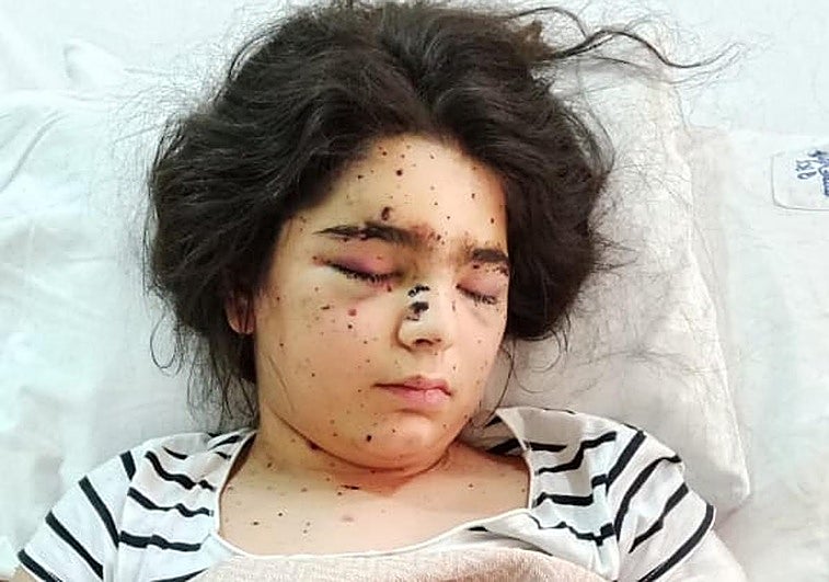 Sara, con los restros de metralla en la cara, en el hospital tras el atentado yihadista de junio en la capital siria