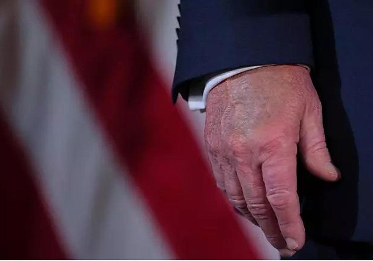 La mano, hinchada y con hematomas, del presidente Donald Trump