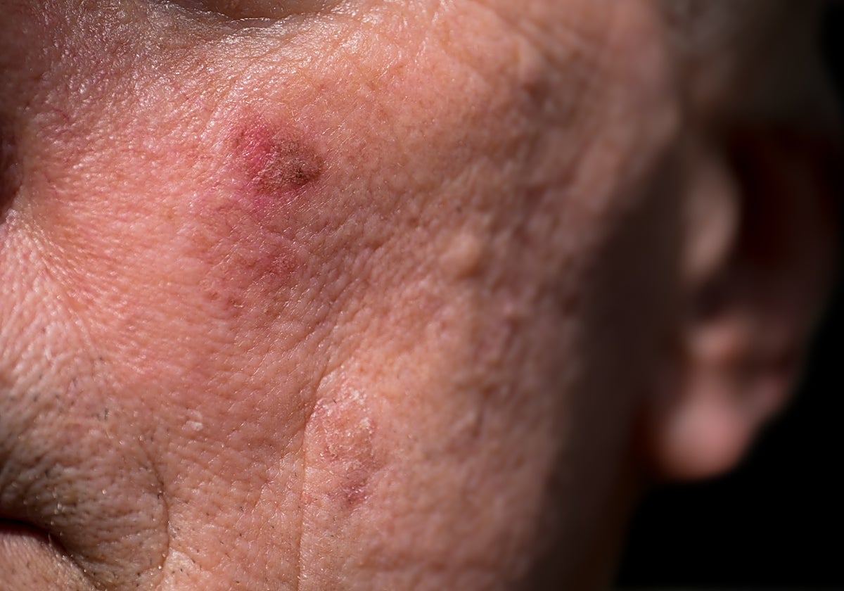 A propósito del cáncer de piel en la edad avanzada