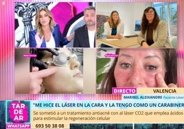 El tratamiento de medicina estética con «resultados impactantes» para eliminar «marcas de acné y arrugas»