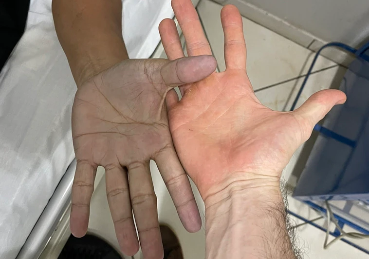 El sorprendente diagnóstico de un paciente que acudió a urgencias con las manos azules