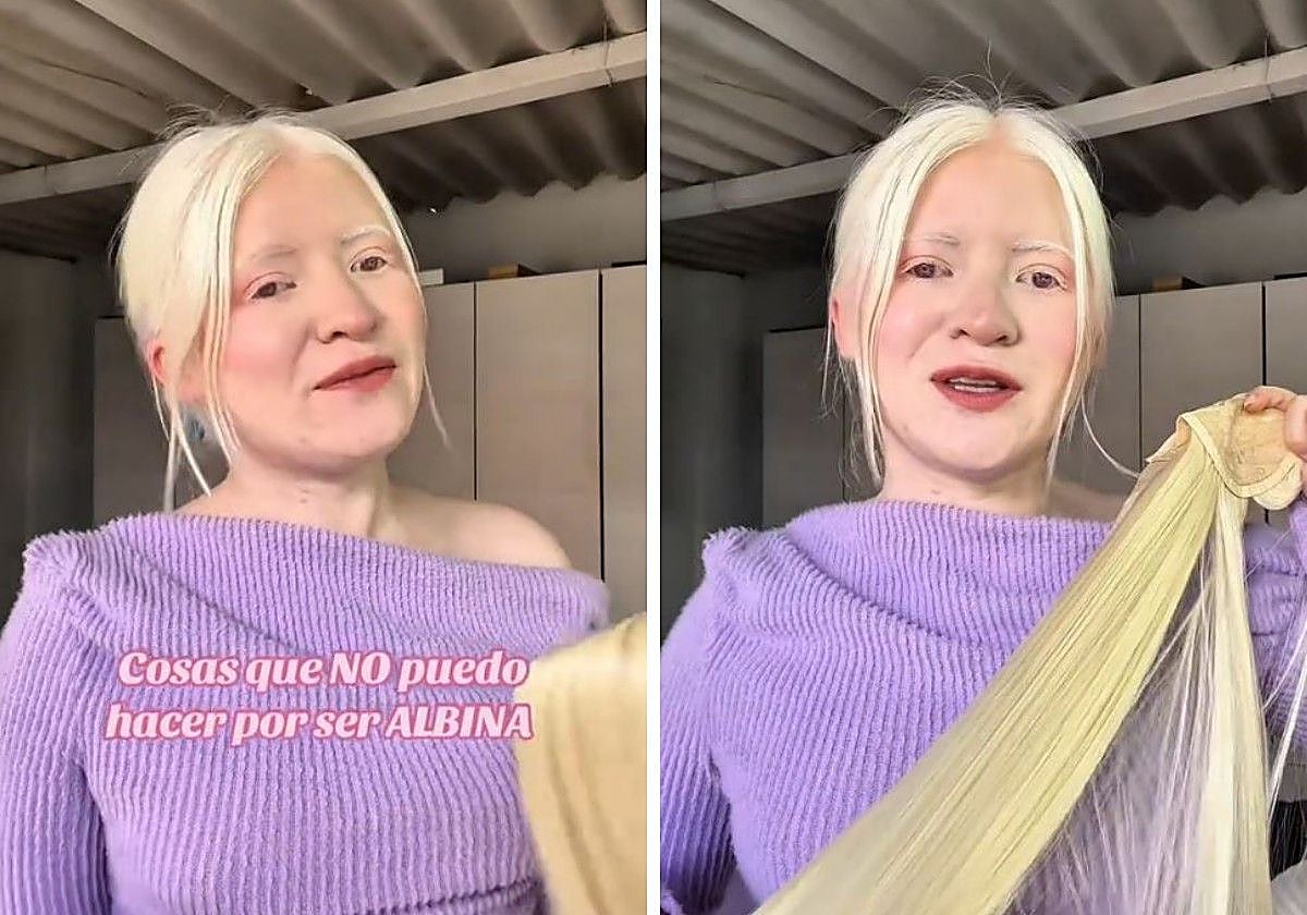 Una joven albina explica todo lo que no puede hacer por la falta de pigmentación