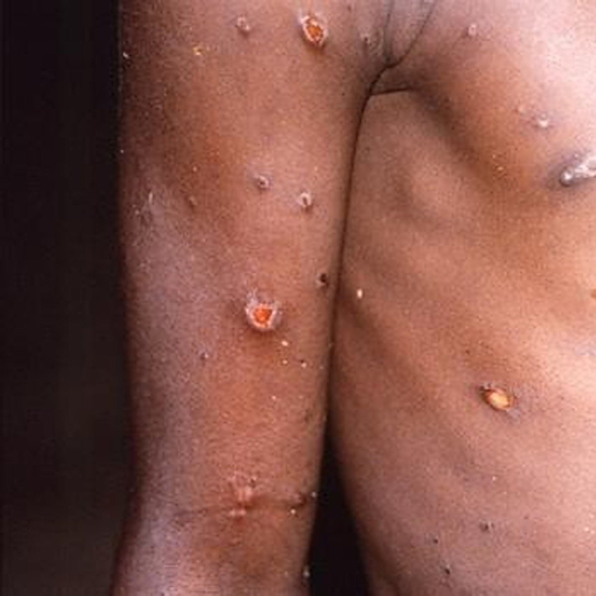 Estos son los nuevos síntomas del actual brote de viruela del mono