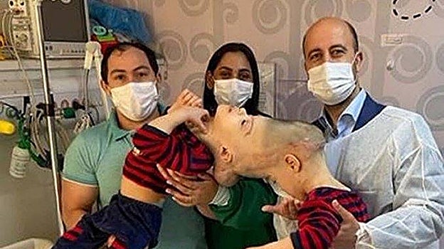 Siameses brasileños unidos por la cabeza han sido separados con éxito