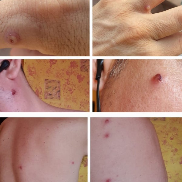 Las tres formas en las que se propaga la viruela del mono: así puedes evitar la infección