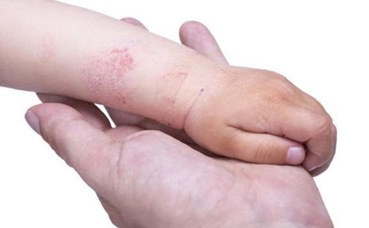 La sequía puede tener muchos efectos perjudiciales para la salud y puede llegar a lastimar nuestra piel