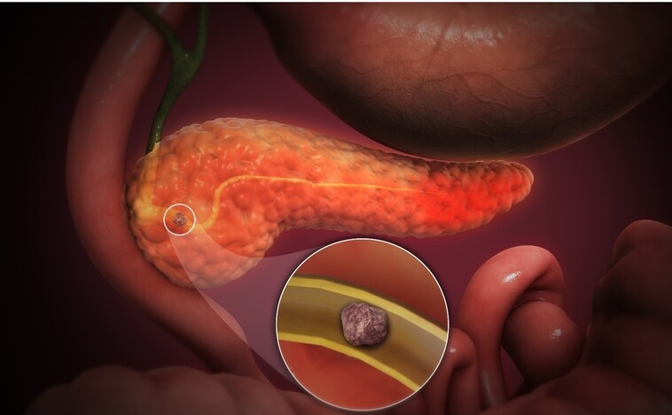 Una investigación española cambia el tratamiento de la pancreatitis