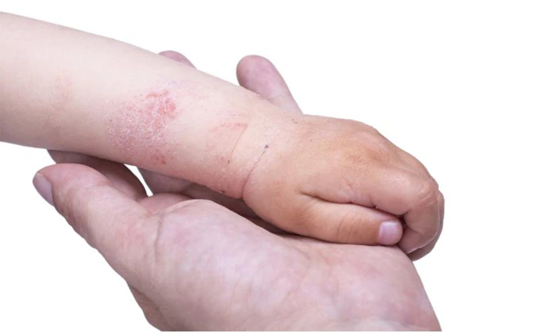 Este fármaco biológico reduce el picor de la dermatitis atópica en menores de cinco años