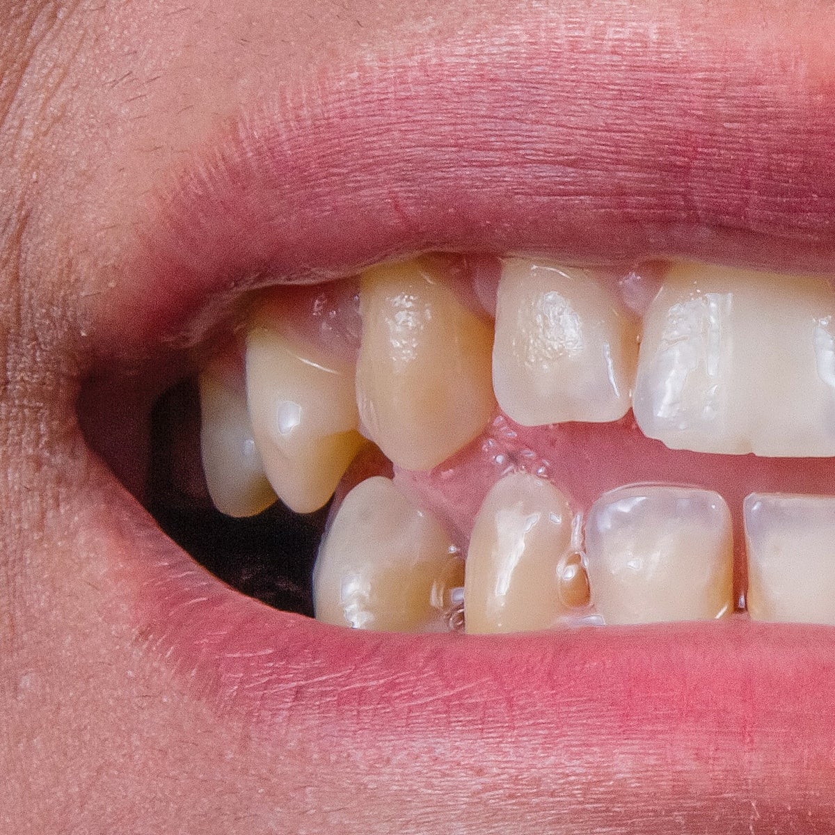 Un gel trata la enfermedad de las encías al combatir la inflamación