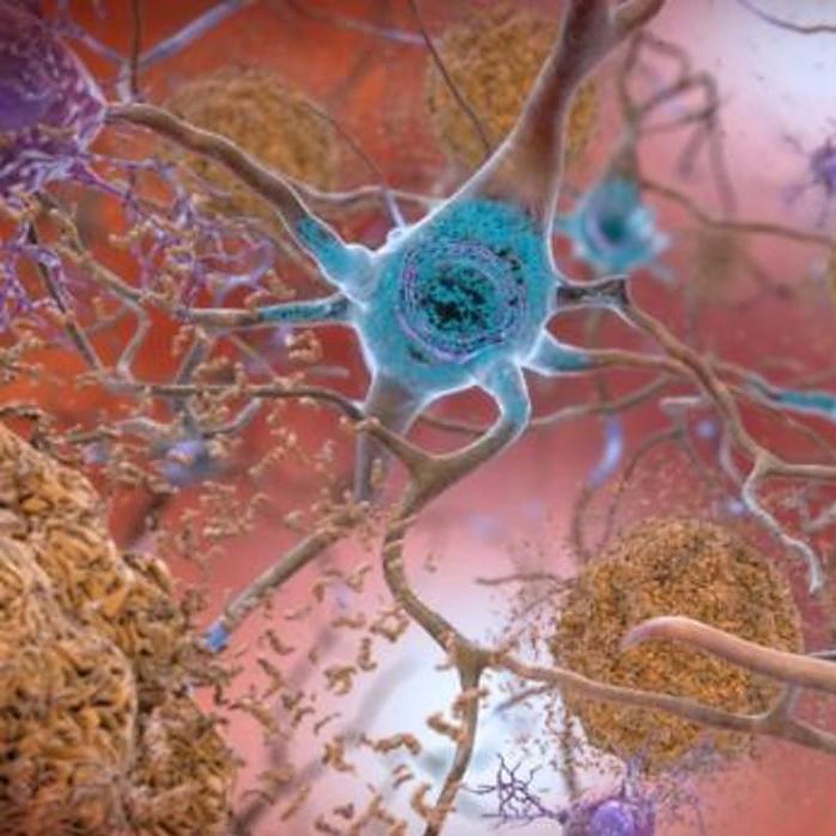 Un nuevo fármaco para el alzhéimer reduce el daño en el cerebro