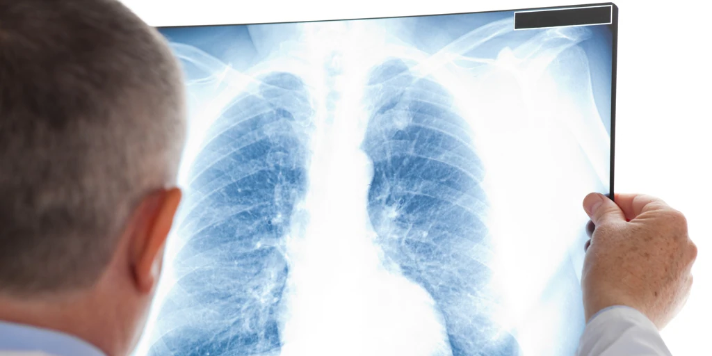 Estos son los síntomas del cáncer de pulmón: hazles caso