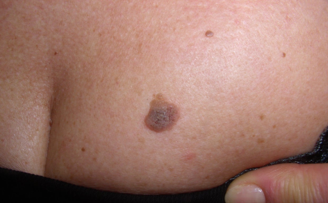 Melanoma