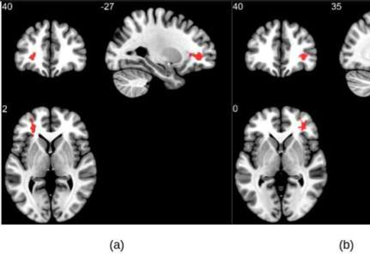 imágenes de resonancia magnética del cerebro