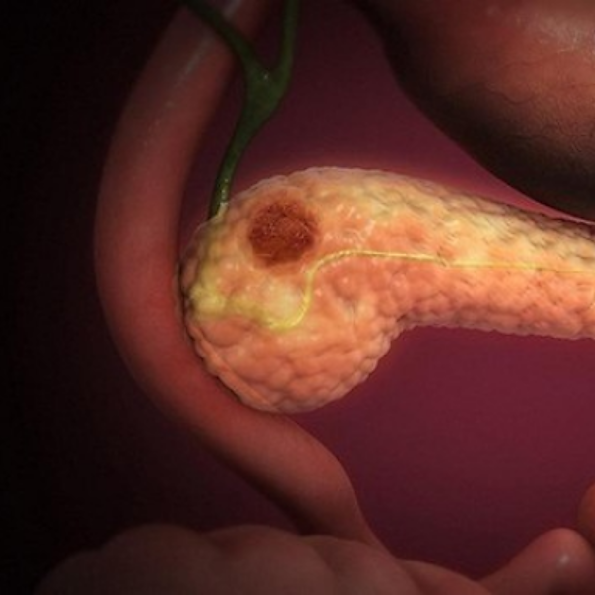 Los 14 síntomas que no debes ignorar del cáncer común más mortal, el de páncreas