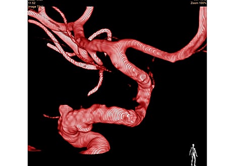 Imagen secundaria 1 -  Arteriografía 3D de aneurisma cerebral en carótida interna izquierda de gran tamaño (15 mm). Arteriografía 3D tras la implantación de stent diversor de flujo en arteria carótida, que muestra trombosisicon cierre total del aneurisma del stent diversor de flujo durante su implantación en el procedimiento. Visualización radiológica del stent diversor de flujo durante su implantación en el procedimiento