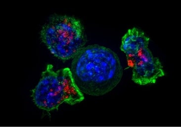 Usan células modificadas de un donante para tratar el mieloma múltiple