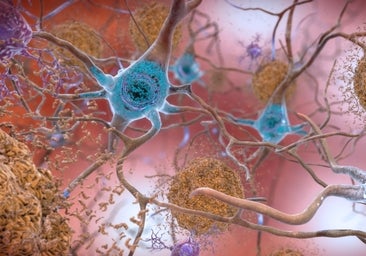 Este test detecta el alzhéimer 3 años antes del diagnóstico
